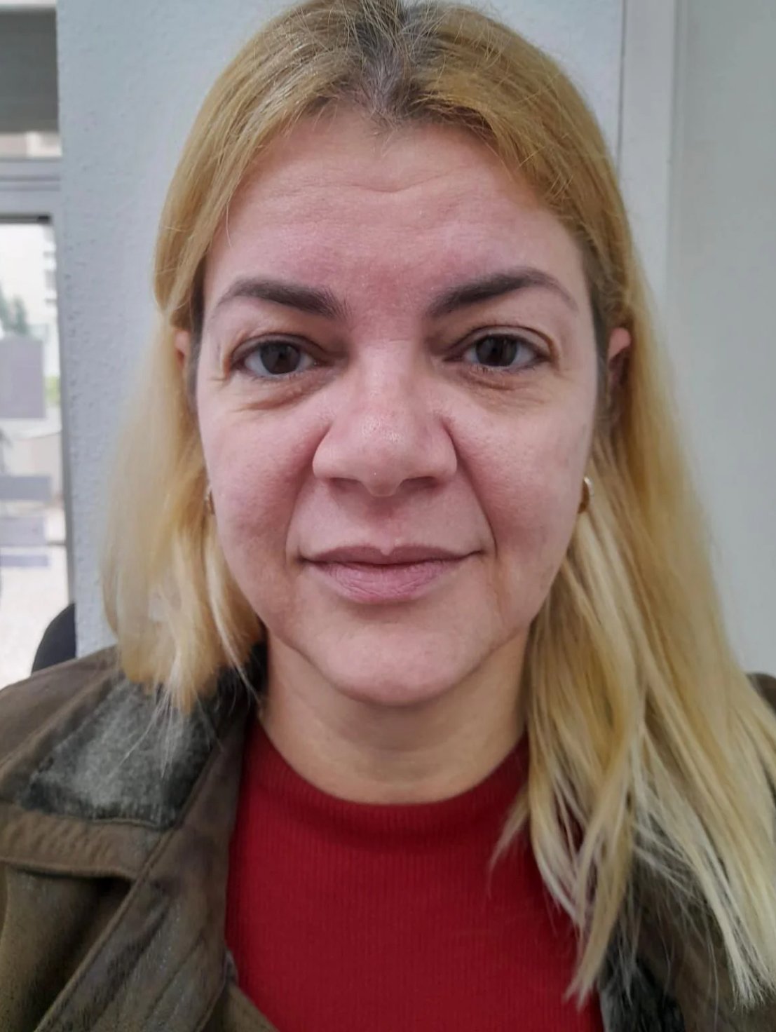 harmonização facial antes e depois